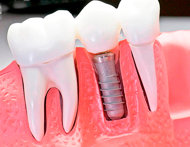 импланты зубные